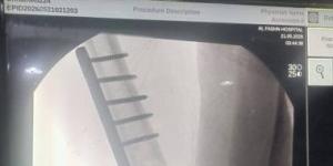 نجاح جراحة دقيقة لتثبيت كسر بالفخذ لطفل بمستشفى الفشن ببنى سويف