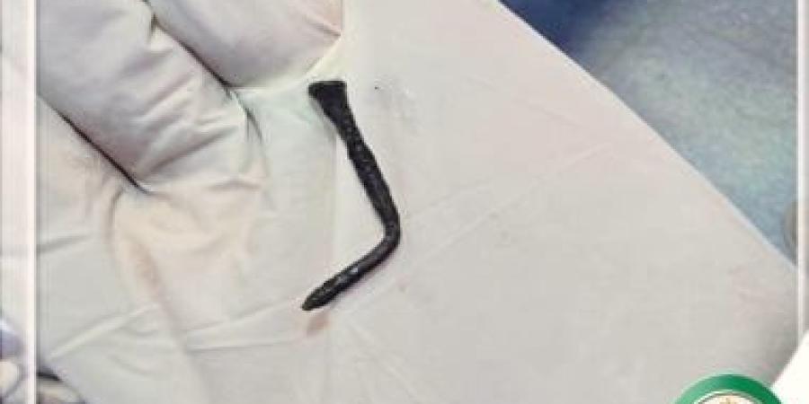 فريق طبى بمستشفى أبو كبير بالشرقية ينقذ طفل ابتلع مسمارا طوله 5 سم